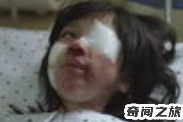 素媛案件真实女孩现在照片（余生当中可能都要带着便袋生活）(4)_