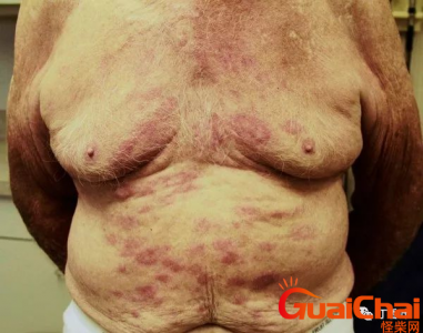 ​麻风病是什么病？麻风病是什么原因引起的？